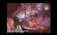 Gastric Sleeve Revision to Mini Gastric Bypass