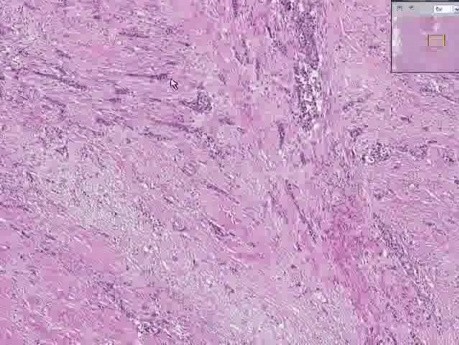 Bladder - Urothelial Carcinoma Grade III