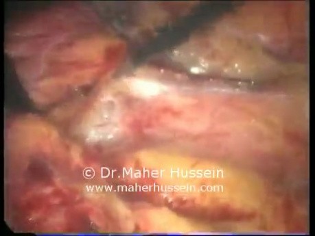 Para aortic LN dissection - Laparoscopic Approach
