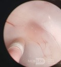 Endoscopic Third Ventriculostomy in a Benign Case of Aicardi Syndrome with Obstructive Hydrocephalus and Chiari Malformation type 1