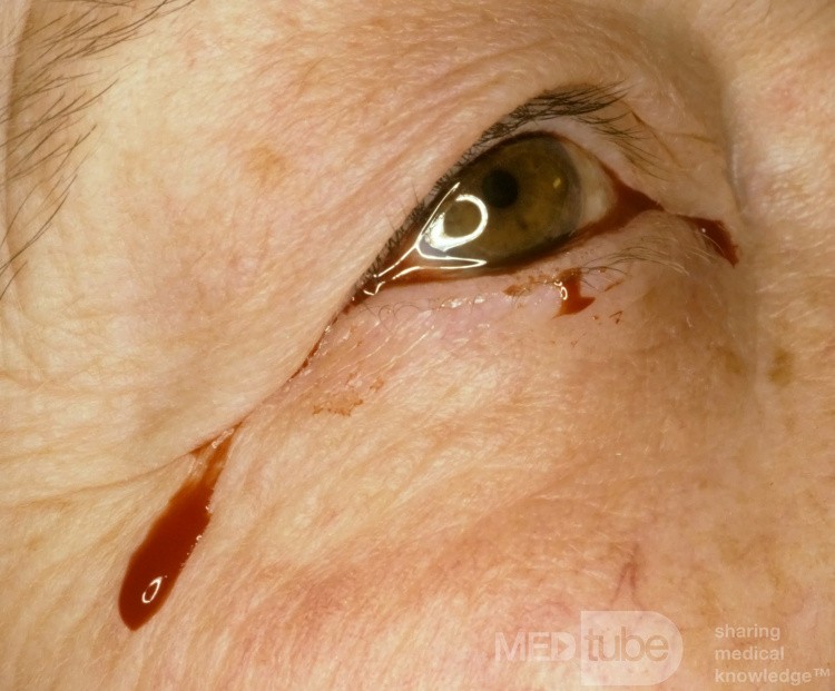 Tears of Blood
