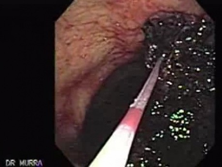 Gastric Cancer - Sclerotherapy, Part 2