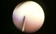 Botox bladder injection - urological simulator