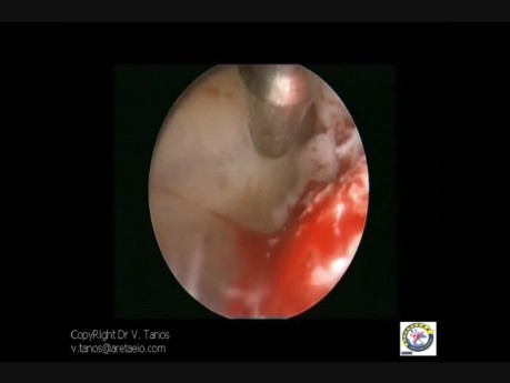 T Shape And Subseptated Uterus