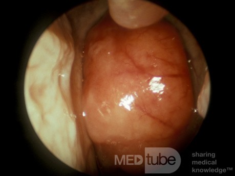 Carcinoma of the Nasopharynx