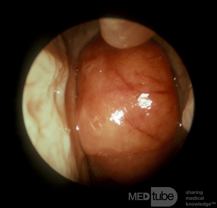 Carcinoma of the Nasopharynx