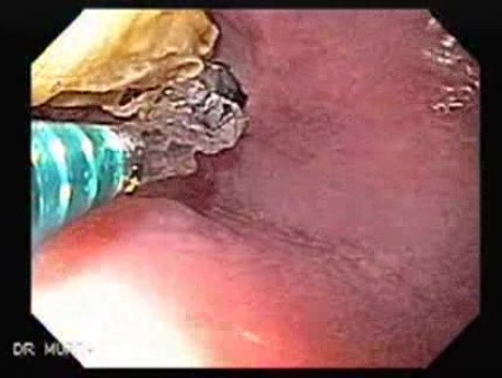 Esophageal Stricture After Total Gastrectomy And Chemoradiation - Baloon Dilation - 2/6