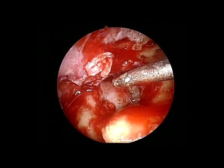 Endoscopic Canal Wall Reconstruction with Fascio-Periosteal Temporal Flap