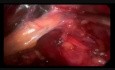 Minilaparoscopic Lumbar Hernia