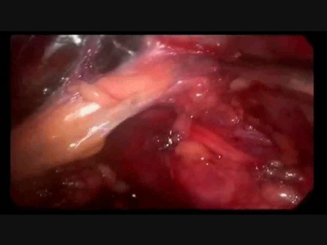 Minilaparoscopic Lumbar Hernia