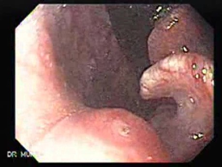 Zenker's Diverticulum - Retroflexed Image of the Nasopharynx