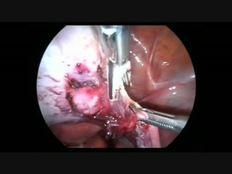Laparoscopic Myomectomy