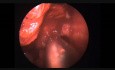 Endoscopic Excision of Inverted Papilloma