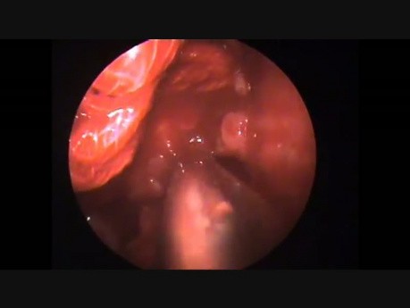 Endoscopic Excision of Inverted Papilloma