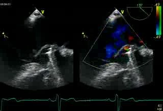 Mitral Regurgitation