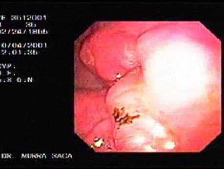 Hereditary Diffuse Gastric Cancer (HDGC) - Endoscopy (1 of 4)