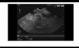 Endosopic Ultrasound of Early Ampullary Lesion