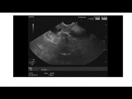 Endosopic Ultrasound of Early Ampullary Lesion