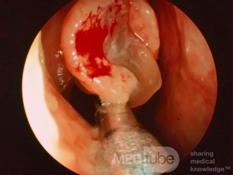 Nasal Polyp Removal with Powered Suction Shaver