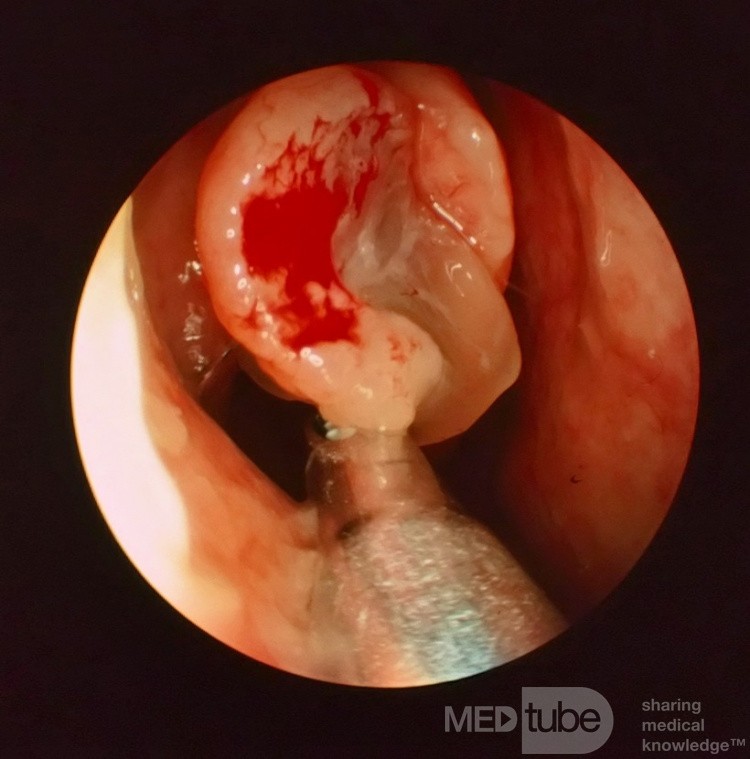 Nasal Polyp Removal with Powered Suction Shaver