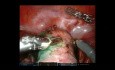 Endometrial Carcinoma - Robotic TLH and SLND