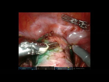 Endometrial Carcinoma - Robotic TLH and SLND