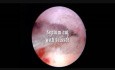Septum Cut with Scissor Hysteroscopy