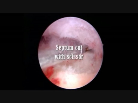 Septum Cut with Scissor Hysteroscopy