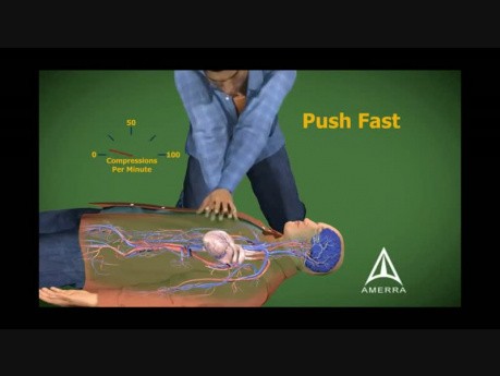 Cardiopulmonary Resuscitation - CPR - 3D Medical Animation