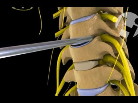 Cervical Discectomy and Fusion