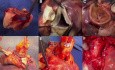 Heart Transplantation with Usage of Both Donor's and Recipient Hearts