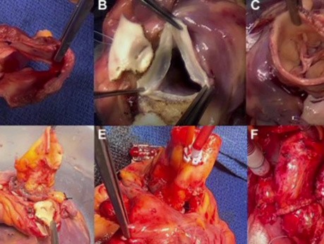 Heart Transplantation with Usage of Both Donor's and Recipient Hearts