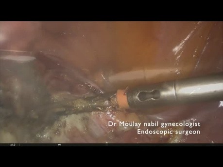 Outpatient total laparoscopic hysterectomy with ovarian conservation
