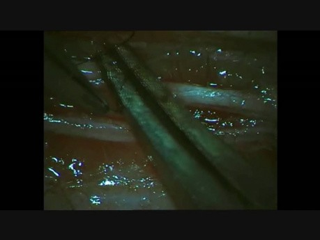 Microsurgery Tutorials. Lesson 16: Microneurorrhaphy With Venous Graft. Rat Saphenous Nerve and Vein