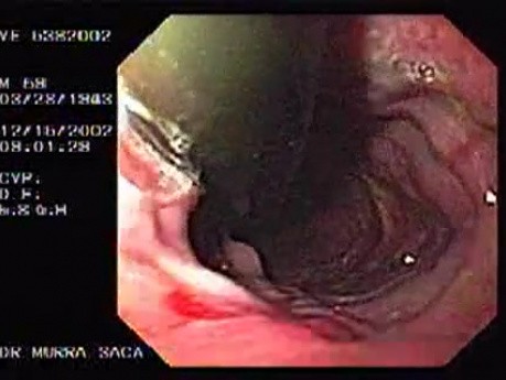 Lower Esophageal (Schatzki) Ring with esophageal varices and Reflux Esophagitis (2 of 2)