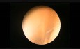  Hysteroscopy: Myoma tipe1 and Endometrial Polyps