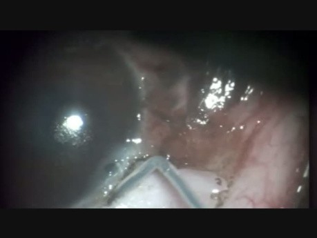 Excision of a Large Conjunctival Naevus, Firt Two Stages