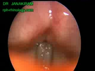Post Mrm Cavity