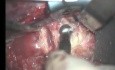 Cervical Corpectomy And Fusion - Anterior Approach