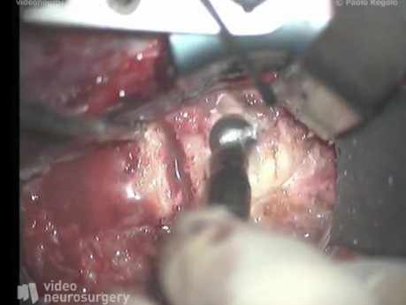 Cervical Corpectomy And Fusion - Anterior Approach