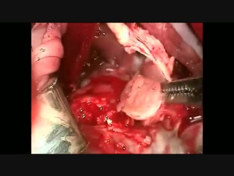 Removal of Right Ventricular Mass and Tricuspid Valve Replacement
