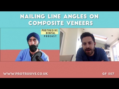 Nailing Line Angles on Composite Veneers