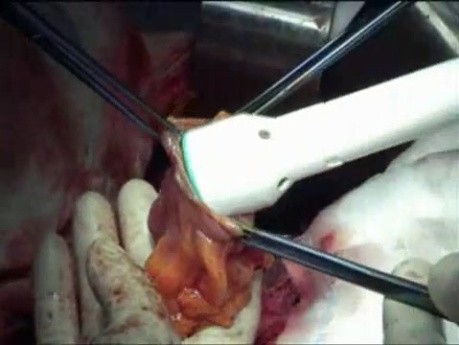 Sigmoid and rectal resection