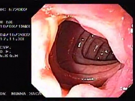 Diverticulitis Of The Sigmoid (1 of 2)