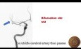 Middle Cerebral Artery Branches