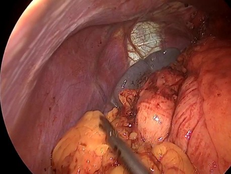 Antireflux Surgery in a Complete Situs Inversus Patient