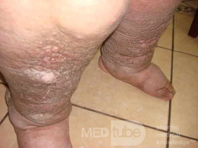 Elephantiasis nostras verrucosa on the legs with morbid
 obesity (4 of 5)