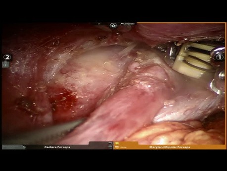 Mediastinal Teratoma