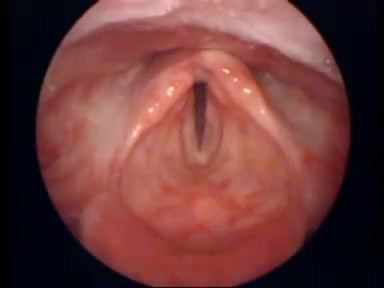 Hoarse Voice after Radiotherapy
