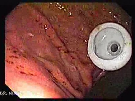 Percutaneous Endoscopic Gastrostomy - PEG (6 of 6)